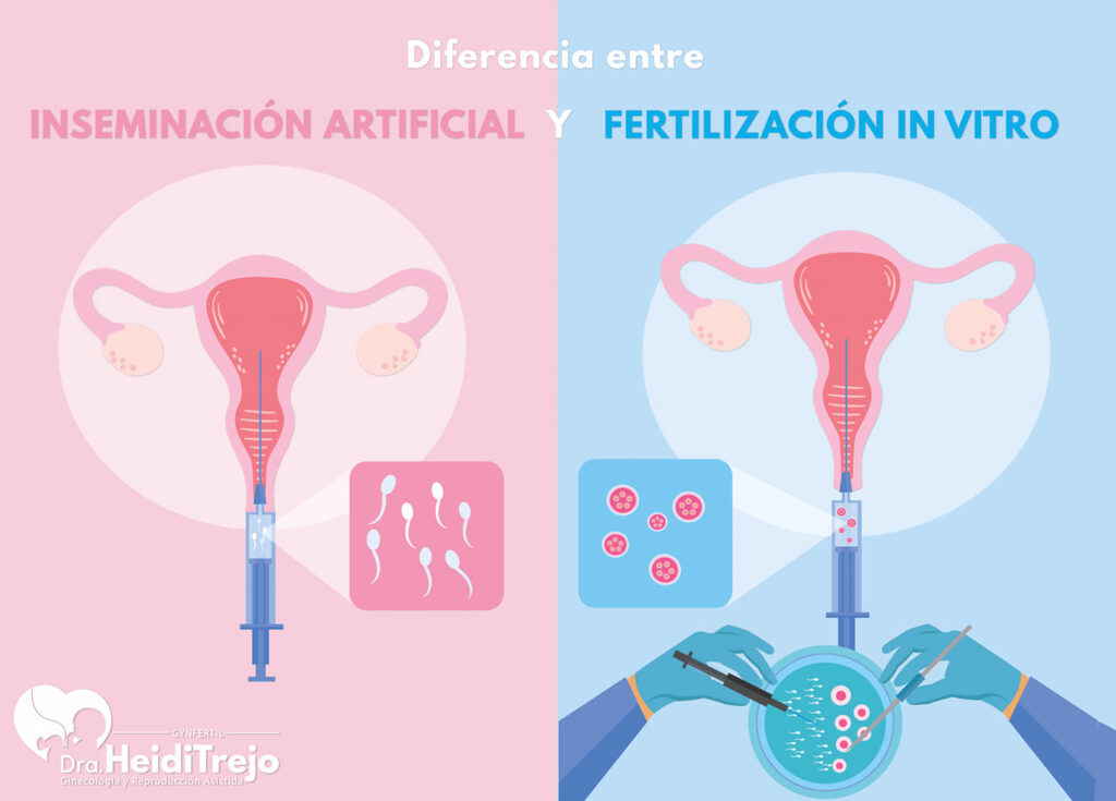 Inseminación Artificial Vs Fertilización In Vitro - Gynfertil